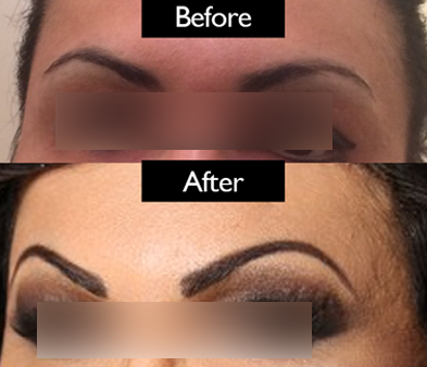 brow-patient2